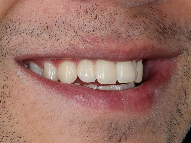 لبخند کامل لترال راست (فتوگرافی دندان پزشکی)