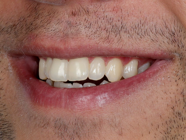 لبخند کامل لترال چپ (فتوگرافی دندان پزشکی)