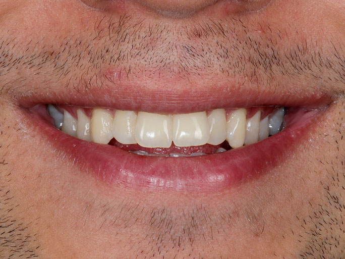 لبخند کامل روبرو (فتوگرافی دندان پزشکی)